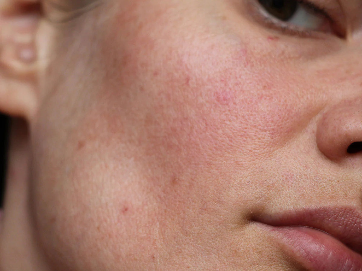 أفضل كريم مرطب للبشرة الحساسة