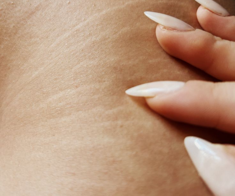 Cellulite & Stretch Marks